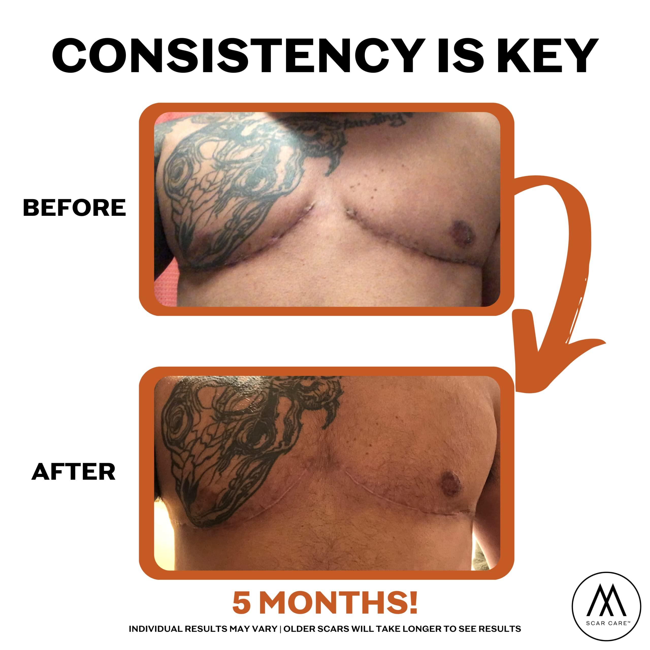 Motivo Scar Care Motivo Advanced Scar Care Bundle: Scar Tape & Roller Serum (10ml) | Water & Sweat Resistant, Long-Lasting, Suitable for All Skin Types | Ideal for Surgical, C-Section, Trauma, & Acne Scars | Espresso