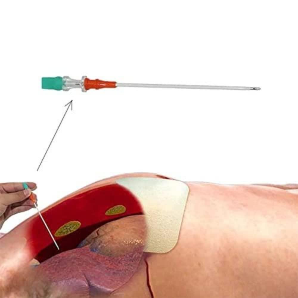 Generic Decompression Needle Used to Treat a Tension Pneumothorax 14g
