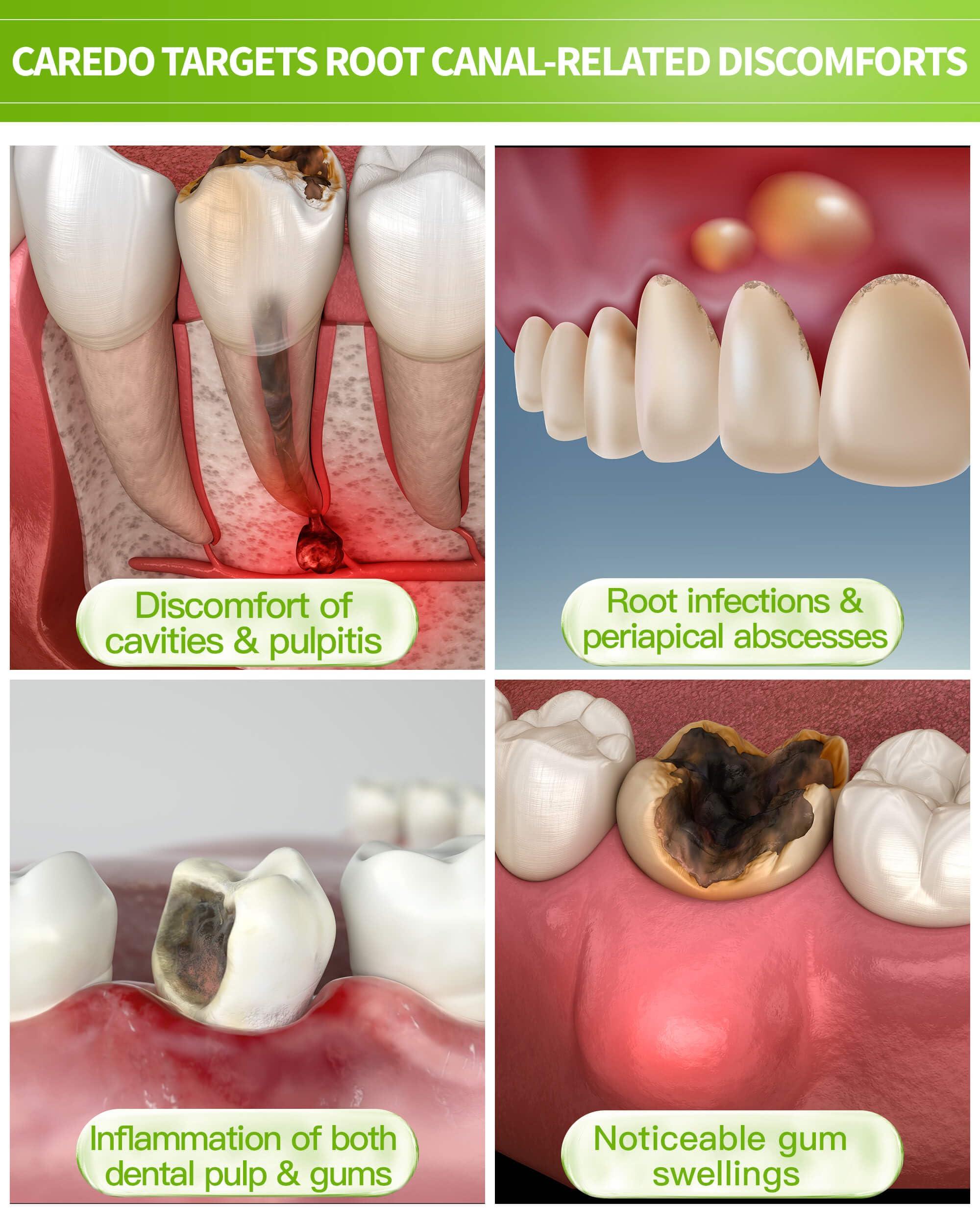 CAREDO CAREDO Gingivitis Toothpaste Avoid Root Canal Pulpitis for Adults, Gingivitis at Home, Gum for Receding Gums with Hydroxyapatite Toothpaste (100g+16g 2pcs)