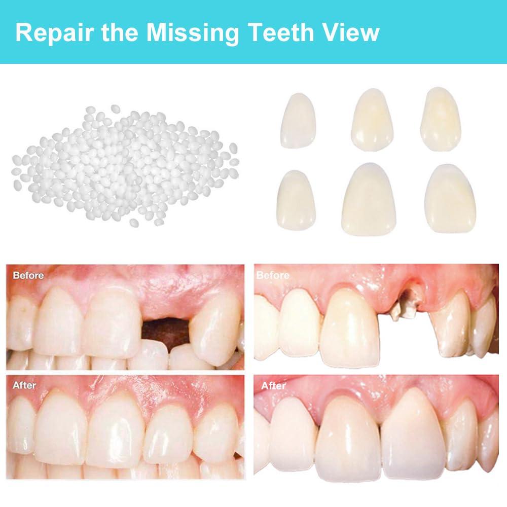 Brige Brige Tooth Repair kit for Filling The Missing Broken Tooth and Gaps-Moldable Fake Teeth and Thermal Beads Replacement Kit