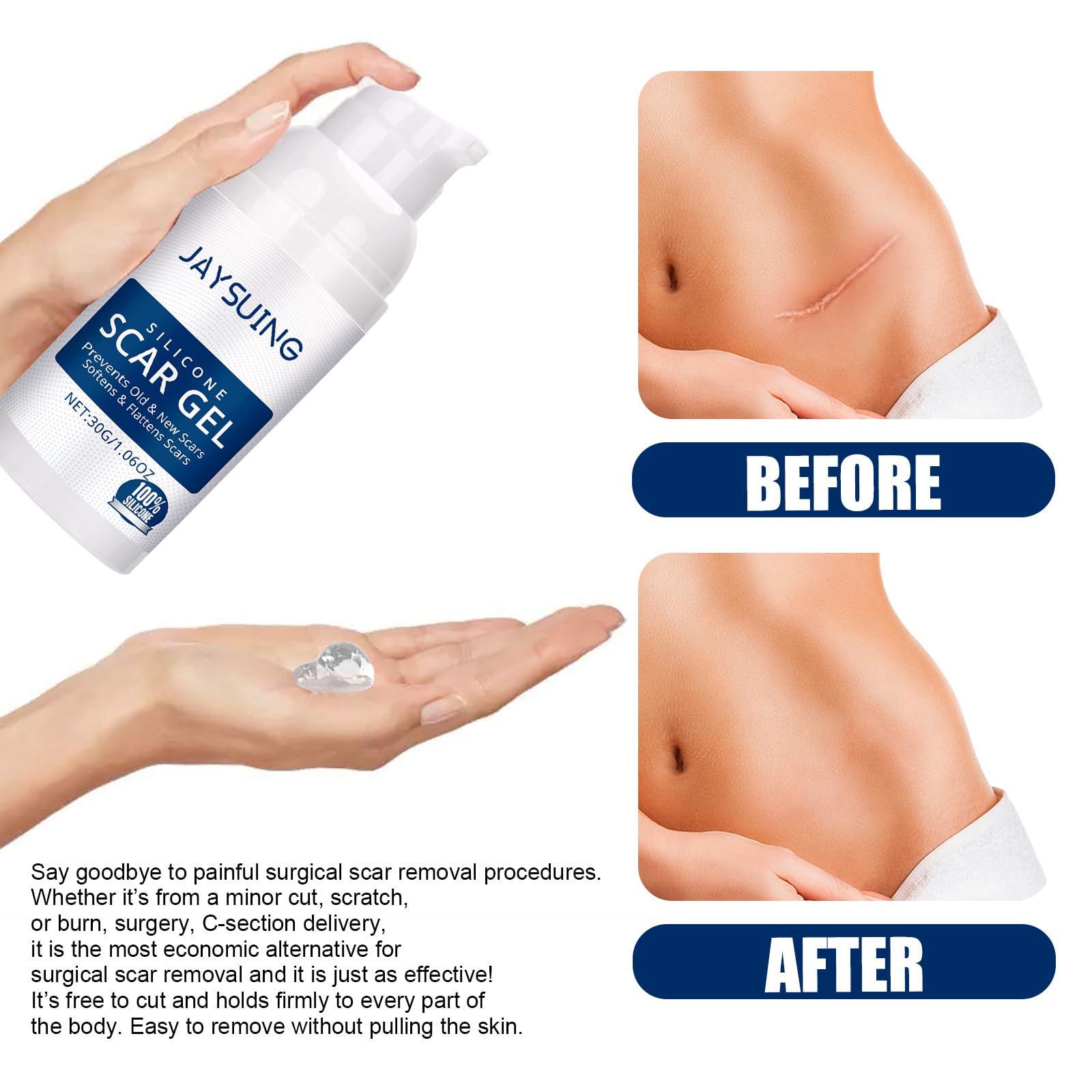 Skin Repair jaysuing Scar Gel Scar Cream for Surgical Scars C-Section Stretch Marks Acne Injury Burns Keloids Hypertrophic For Old & New Scars