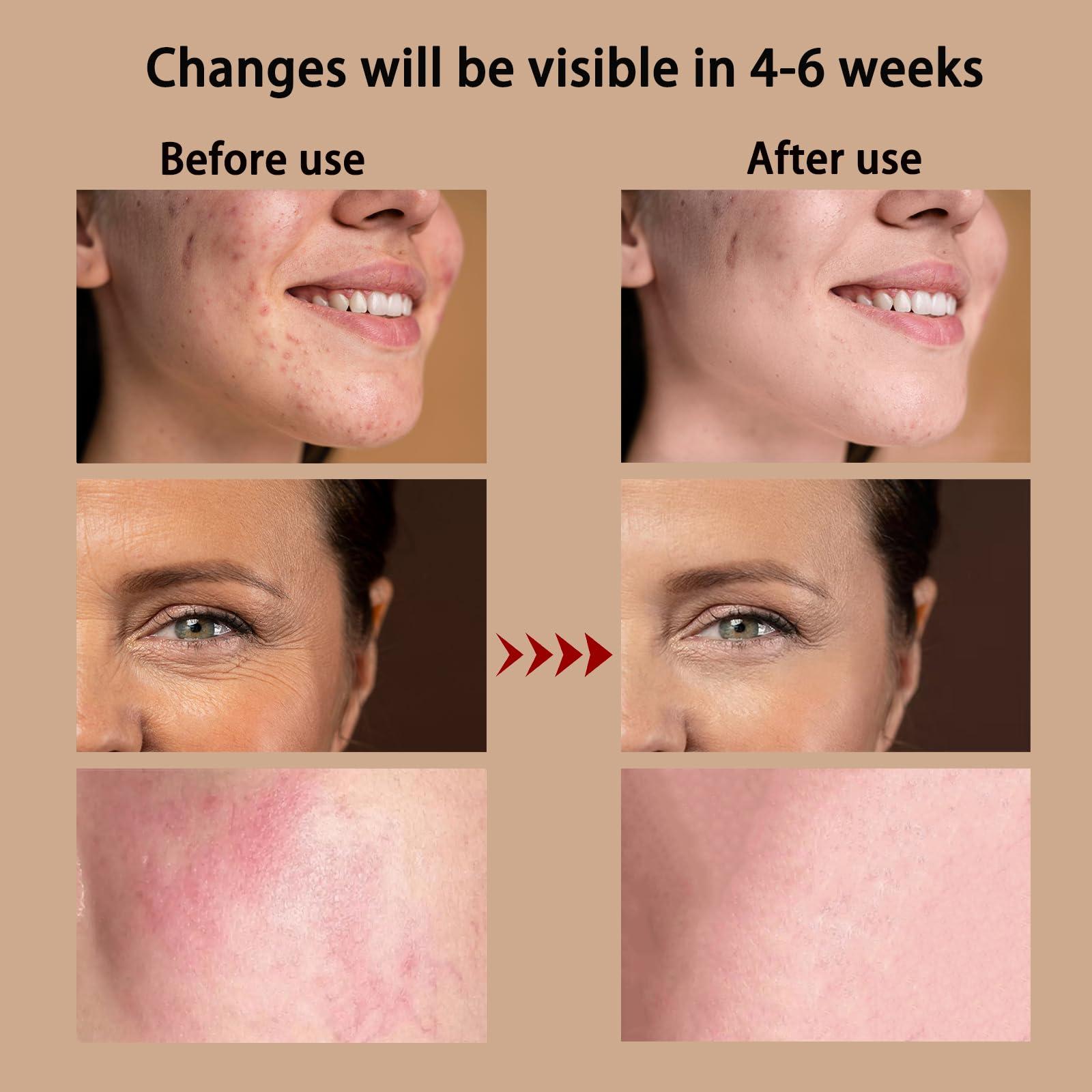 Aymeyly Ultra-Light Weight Red Light Therapy Mask, High Irradiance Red Light Therapy for Face, Comfortable Red Light Mask for Home Use