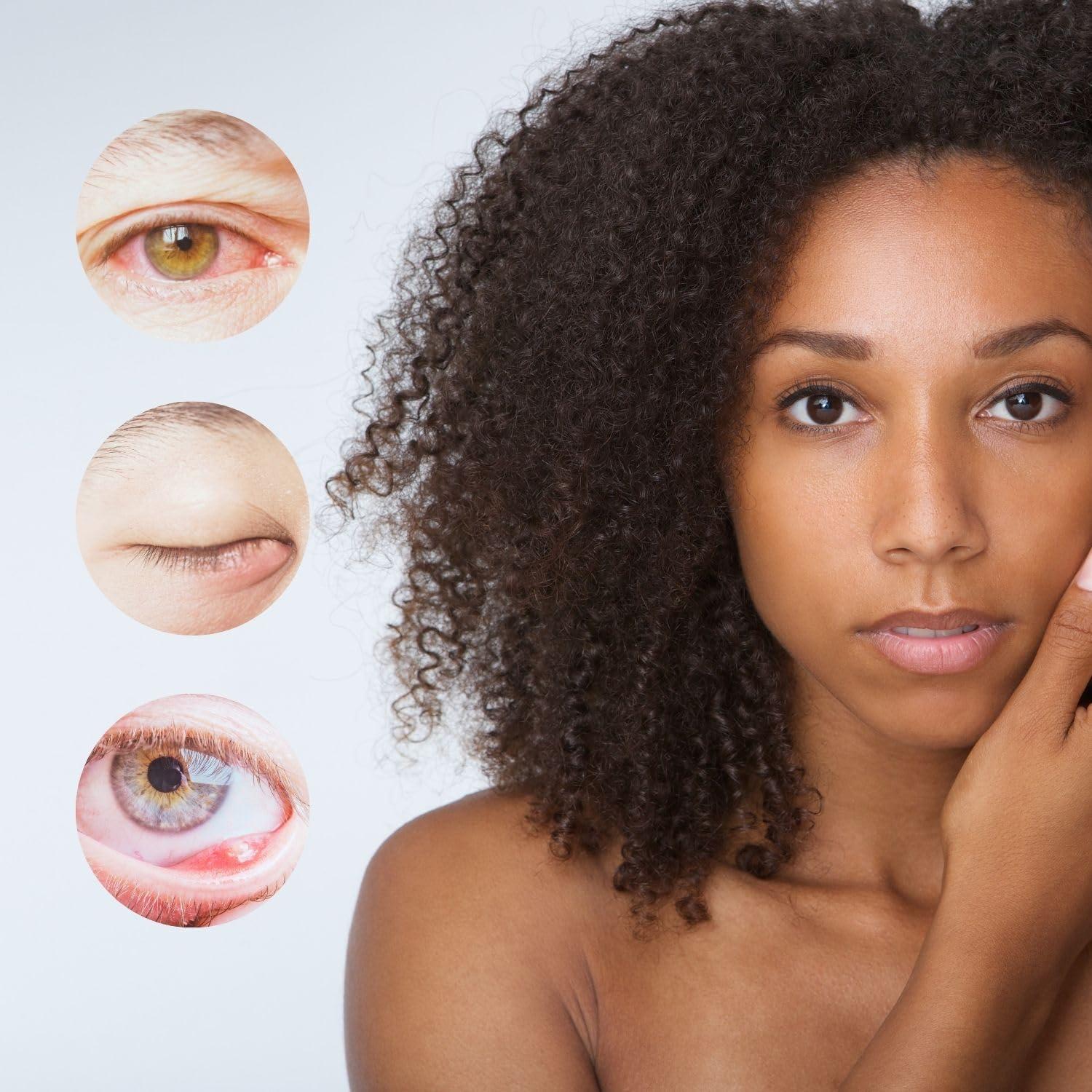 brazmedics brazzoMD Stye Relief - Physician-formulated - Assists Chalazions, Made with Arnica & Calendula 1.0 Fl Oz.