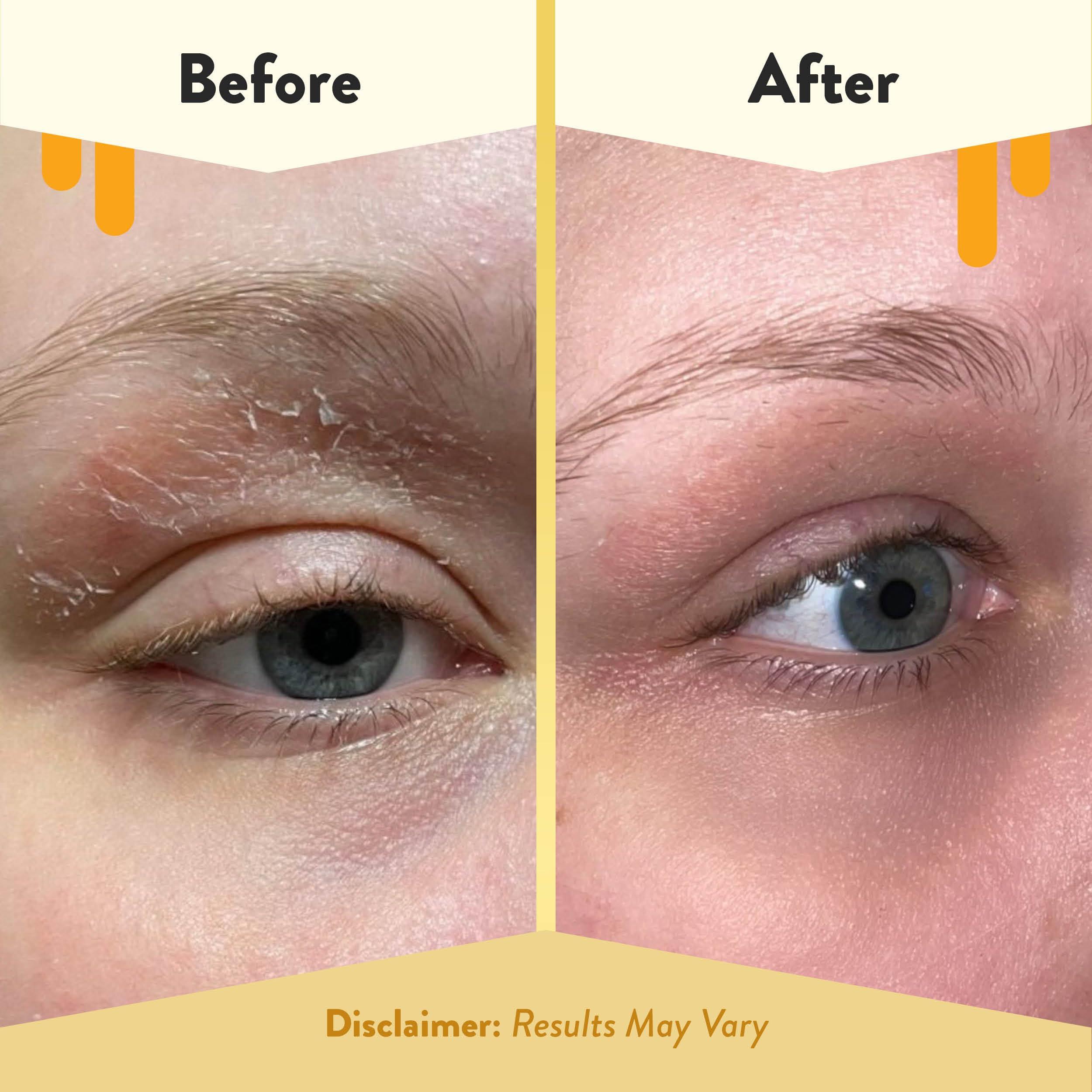 ECZEMA HONEY ECZEMA HONEY Multi Peptide Eye Cream - Anti Aging Eye Cream for Dark Circles & Puffiness - Facial Skin Care Products for Eczema, Dry & Sensitive Skin (0.5 Oz)