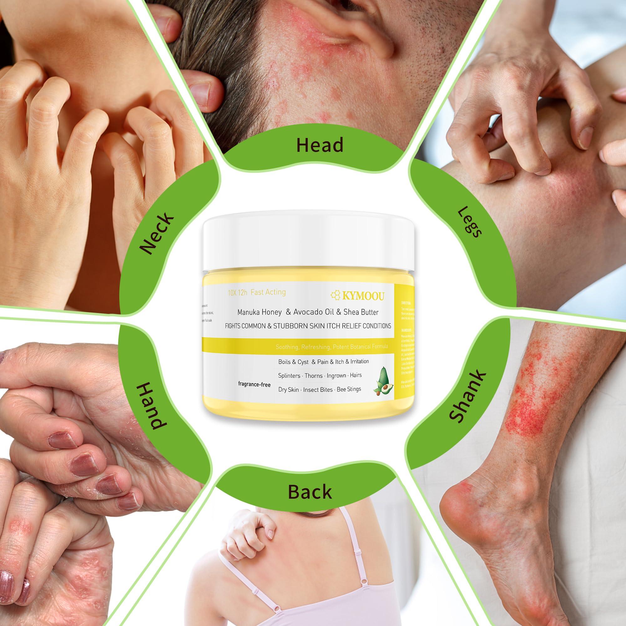 KYMOOU 4 PCS Manuka Honey Tea Tree Drawing Salve Cream Ointment for Boil, Cyst Removal Patch, Splinter Remover, Boil Ease, Ingrown Hair, Chigger, Carbuncle, Pilonidal, Bug, Mosquito, Spider Bites, Bee Sting