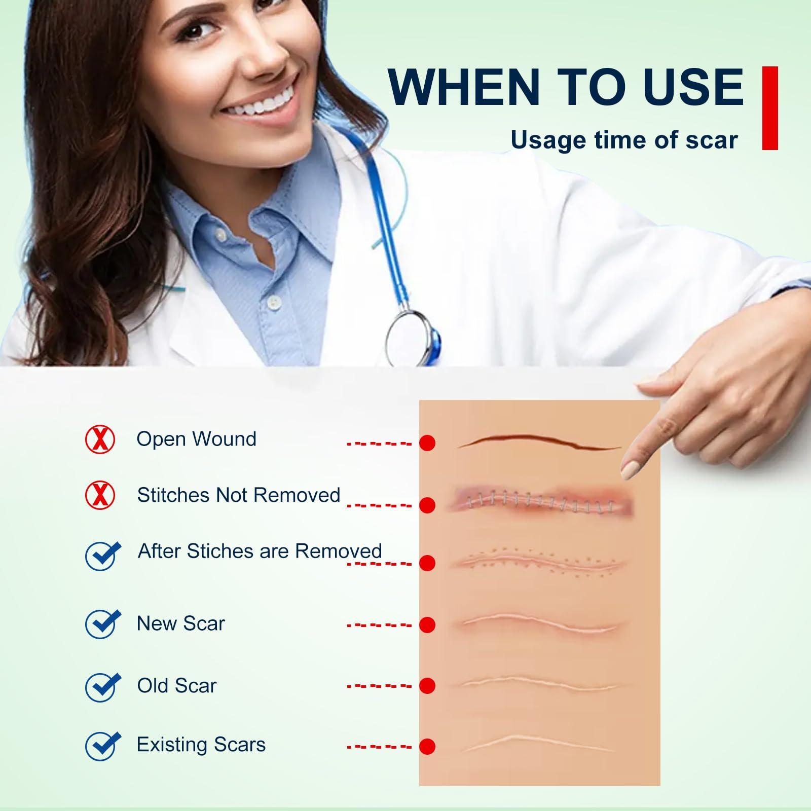 Moulis Silicone Scar Sheets (1.6” x 120” Roll-3M), Silicone Scar Tape Roll, Scar Silicone Strips, Reusable, Professional Scar Removal Sheets for C-Section, Surgery, Burn, Keloid, Acne et