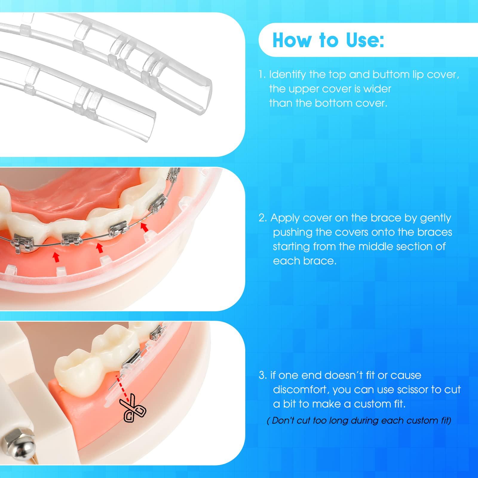 OBrush Obrush Comfort Covers for Braces - Orthodontic Mouth Guard, Lip Protector, Wax Alternative, Lip Shield for Brackets