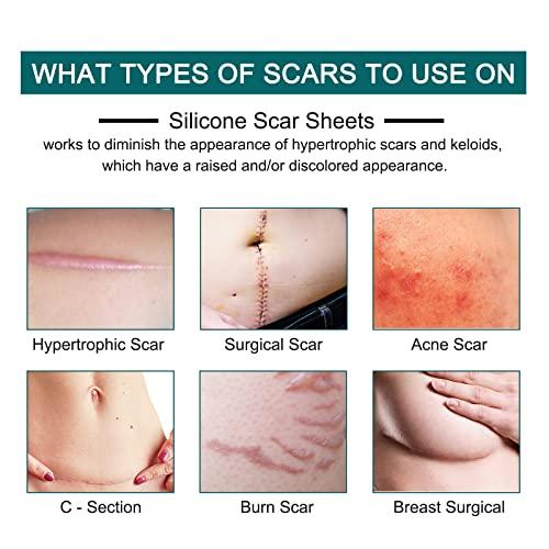 Moulis Silicone Scar Sheets (1.6” x 120” Roll-3M), Silicone Scar Tape Roll, Scar Silicone Strips, Reusable, Professional Scar Removal Sheets for C-Section, Surgery, Burn, Keloid, Acne et