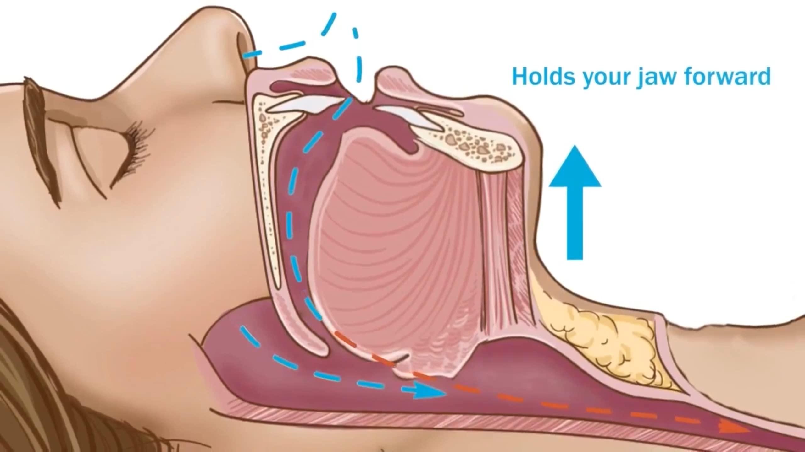 Dentemp Dentemp SleepTight Mouthpiece Anti Snoring Device - Custom Fit Snoring Mouthguard for a Sleep Apnea - Device Designed by Dentist and Made in USA 1pk