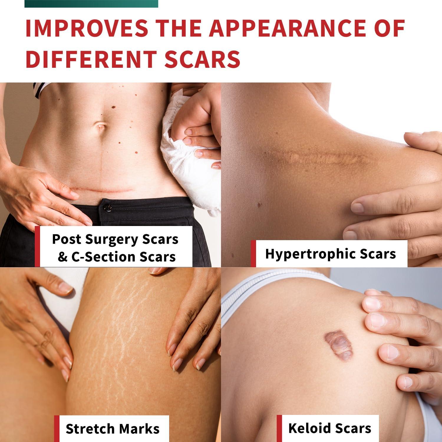 Protect Life Medical Grade Silicone Scar Tape Advanced Adhesive Formulation (1.6" x 118") Scar Removal Away Strips for Surgical Scars, Silicone Tape & Keloid Scar Treatment, Reusable Silicone Scar Sheets