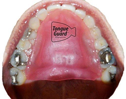 Tongue Guard RPE Tongue Guard: Prevents and Helps Heal Tongue Sores Caused by Dental Expanders