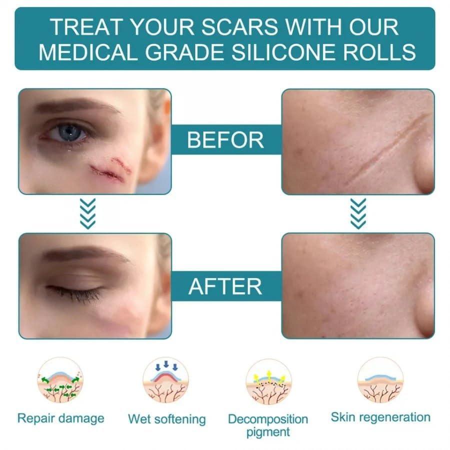 DHAMELIYA DD Silicone Scar Sheets, Silicon Gel Sheets for Scars Transparent Medical Silicone Gel Tape for Scar Removal, Silicone Scar Tape Roll for Hypertrophic Scars and Keloids Caused by Surgery