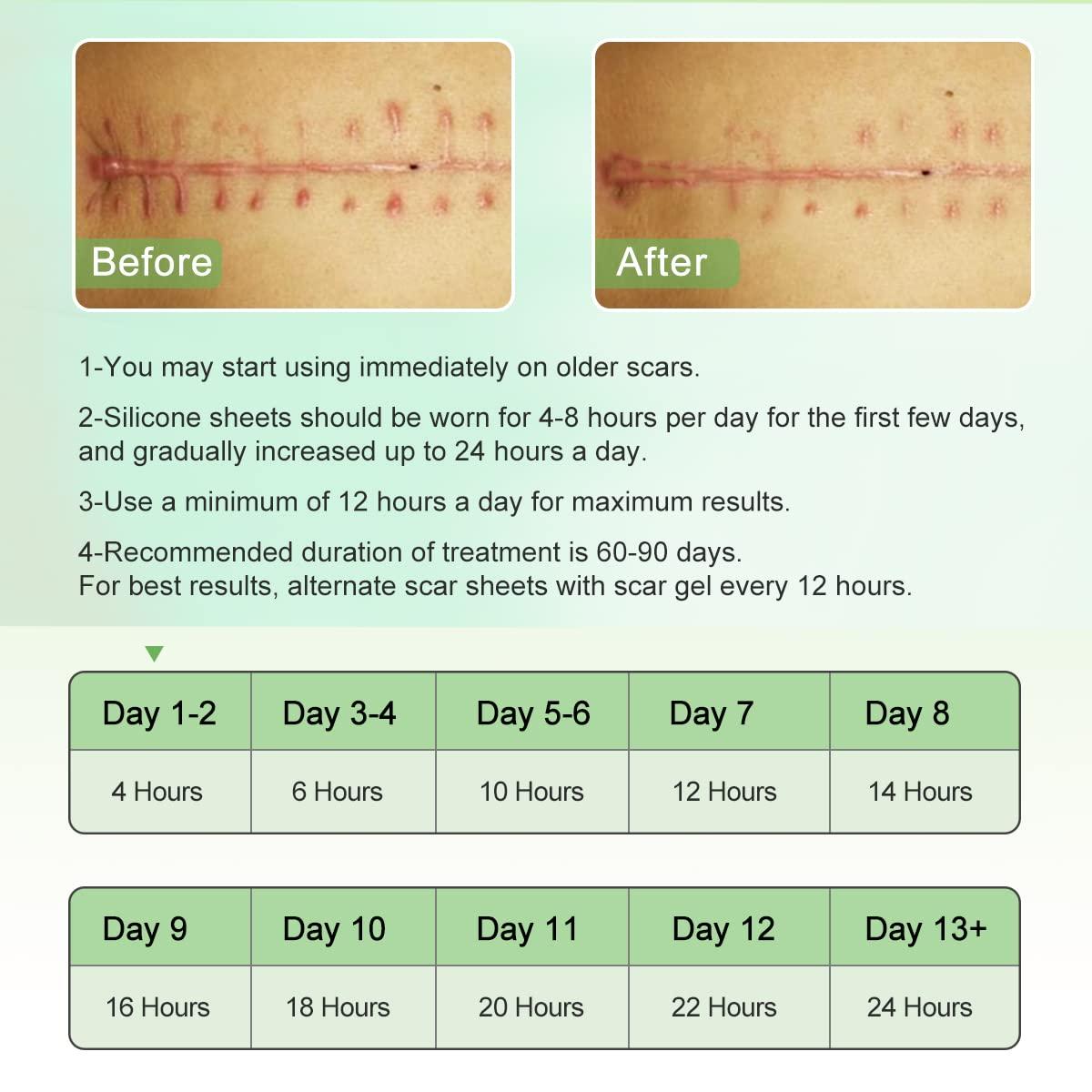 Moulis Silicone Scar Sheets (1.6” x 120” Roll-3M), Silicone Scar Tape Roll, Scar Silicone Strips, Reusable, Professional Scar Removal Sheets for C-Section, Surgery, Burn, Keloid, Acne et