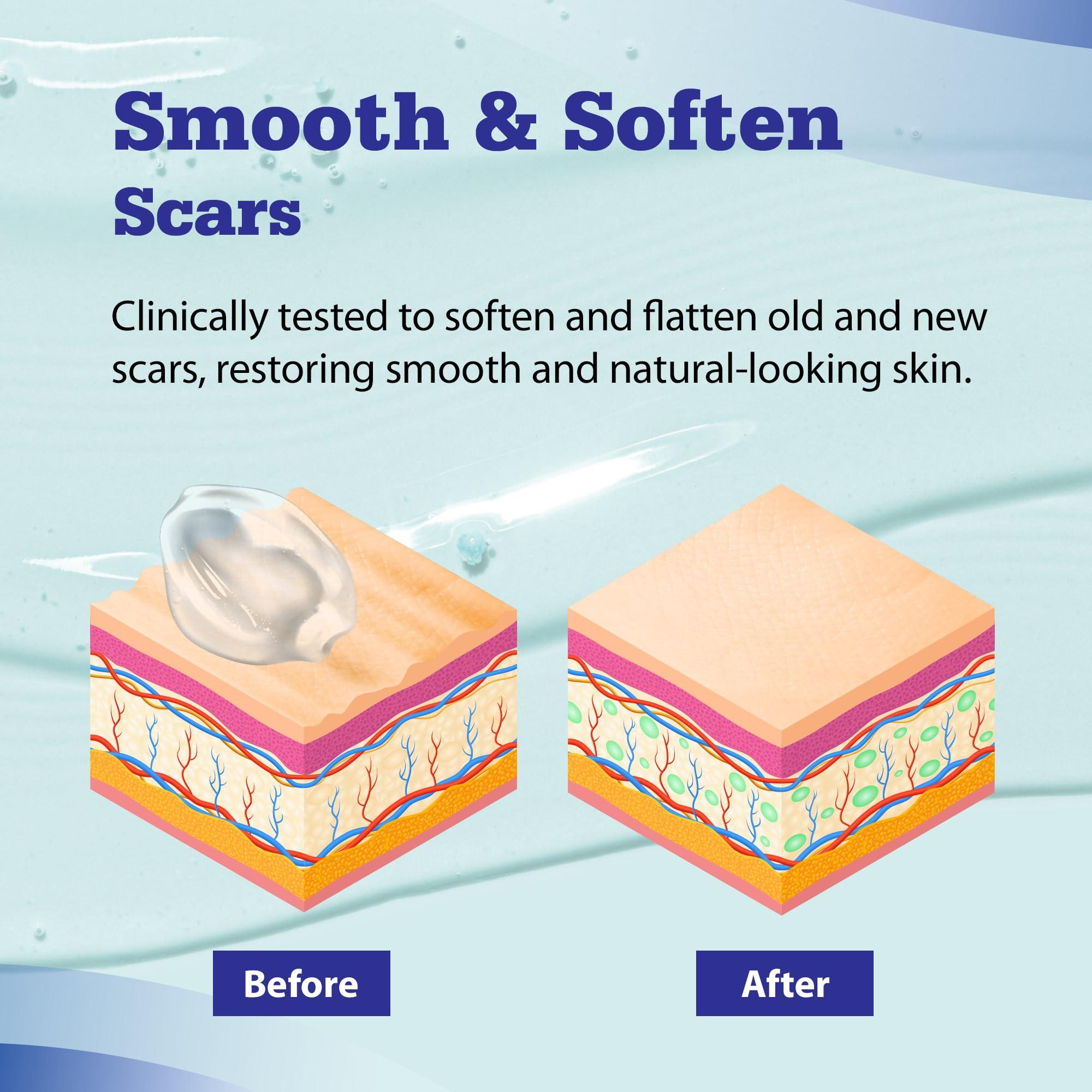 Aroamas Scar Aroamas Scar Advanced Scar Gel - Medical-Grade Silicone Scar Gel for Surgical Scars, for Face, Scar gel with silicone for Keloids, C-Section, Cosmetic Procedures, Burns, Injuries - 45g