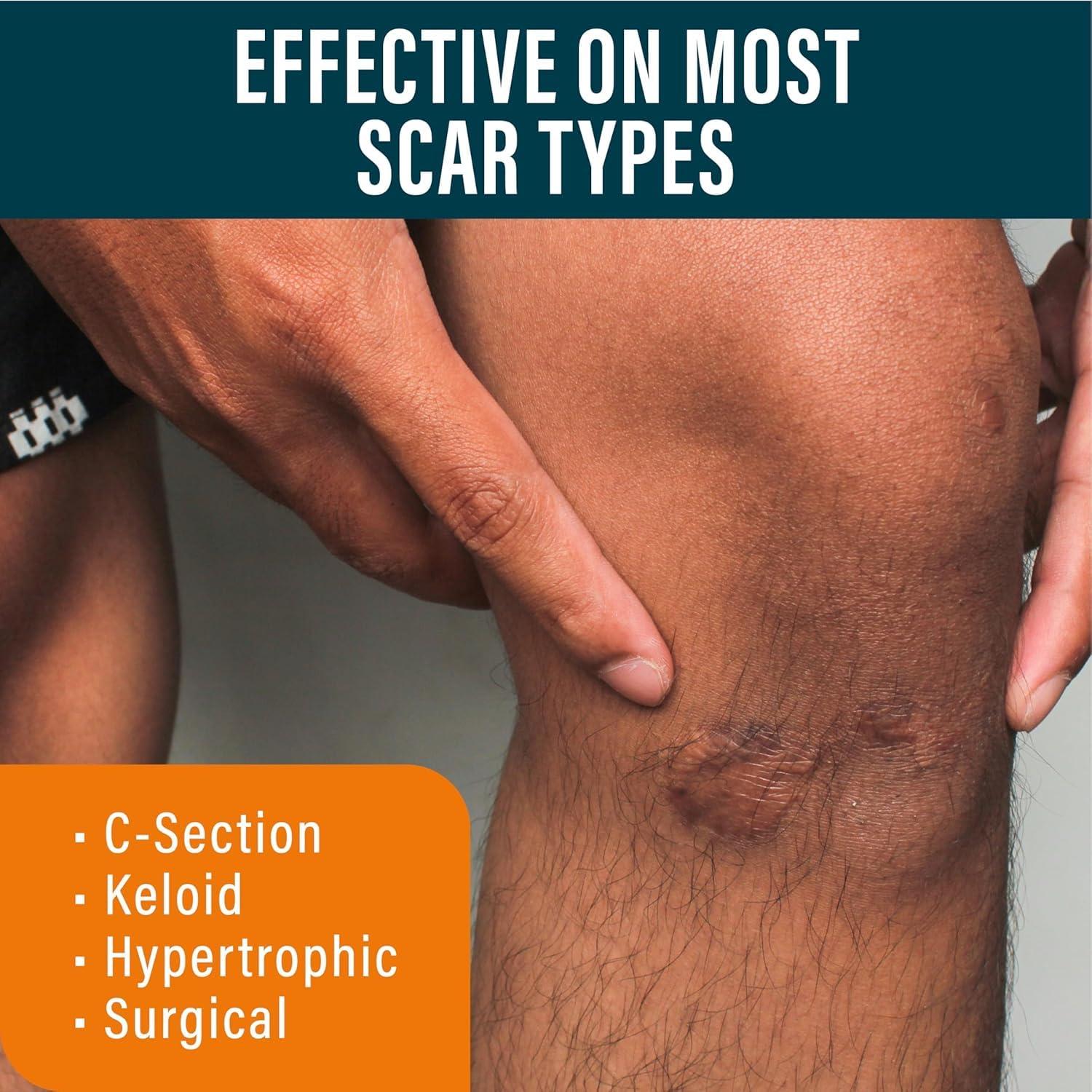 NUVADERMIS NUVADERMIS Extra Long Silicone Scar Sheets with Scar Gel Reusable Medical Grade Sheets for C-Section, Tummy Tuck, Keloid, and Surgical Scars