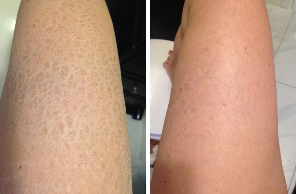 G16 Lotion G16 Skin Repair, Very Dry Skin & Ichthyosis Treatment Cream & Lotion