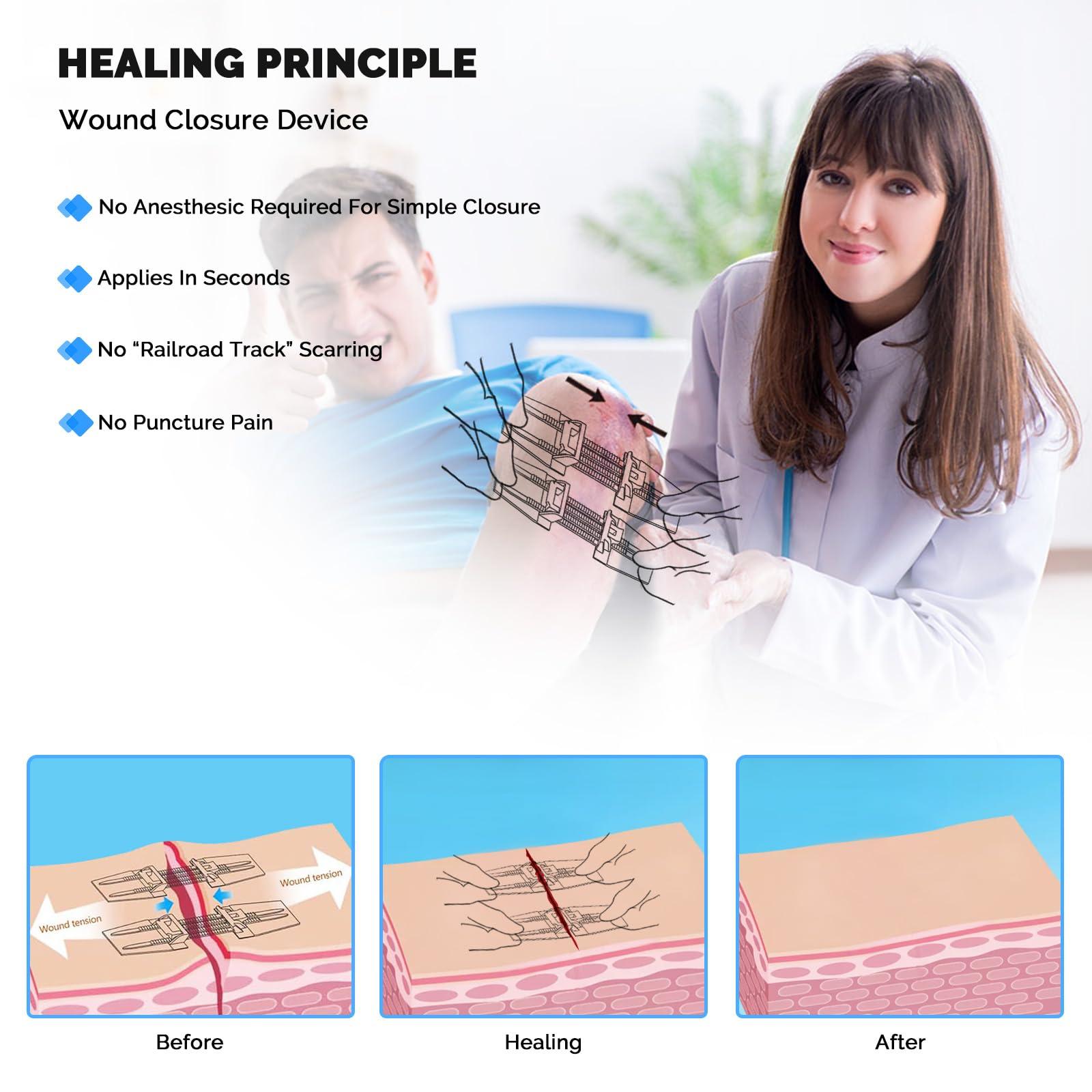 Greetmed Emergency Wound Closure Device 10 Pcs Zip Stitch Wound Closure Strips Laceration Kit Sutures Bandaids for Wounds Repair Without Sew Quick Clot First Aid Wound Care for Outdoor Hiking