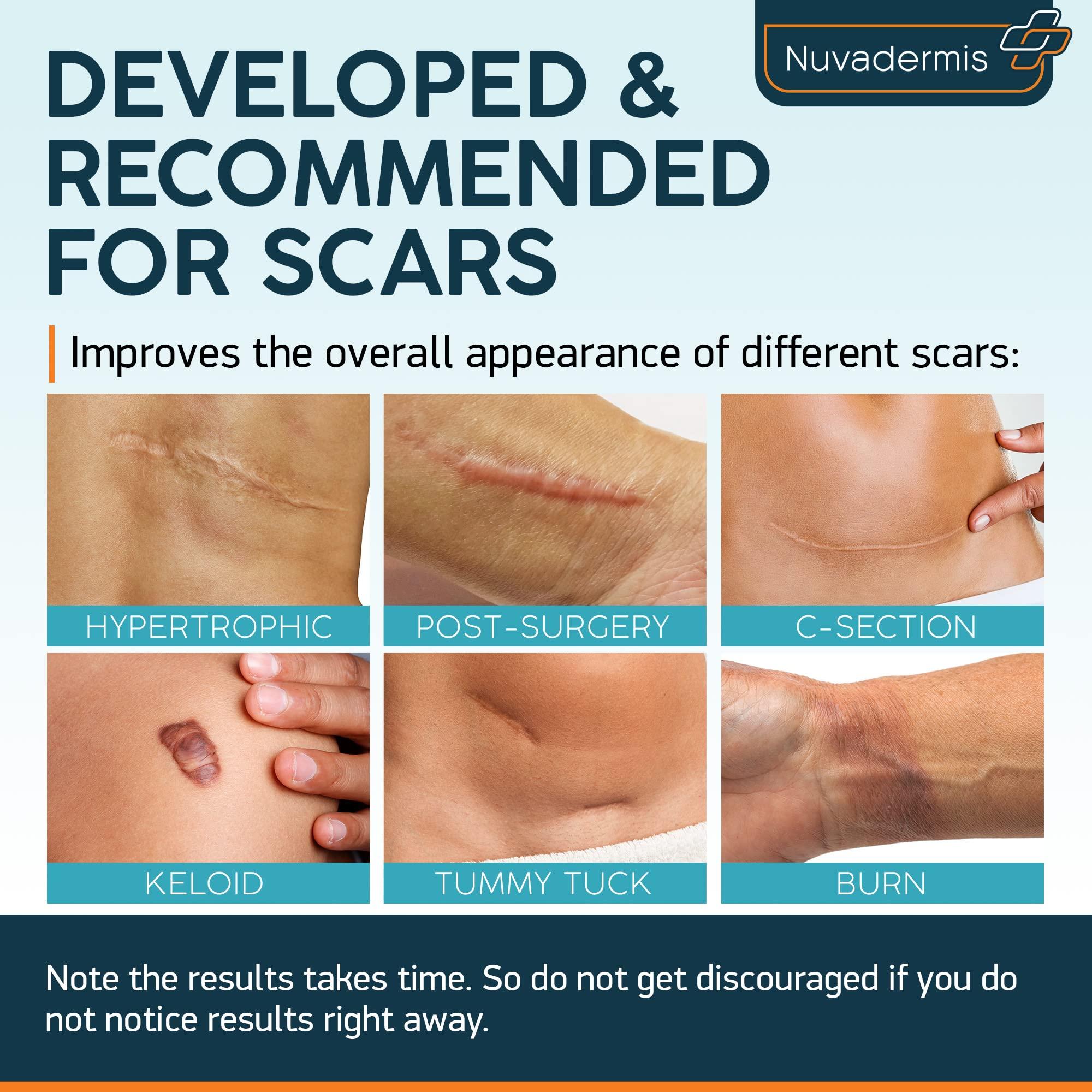NUVADERMIS NUVADERMIS Silicone Scar Sheets & Scar Cream Gel - C-Section, Tummy Tuck, Keloid, Acne Removal Treatment - Advanced Post Surgery Supplies - Scars Removal Treatment