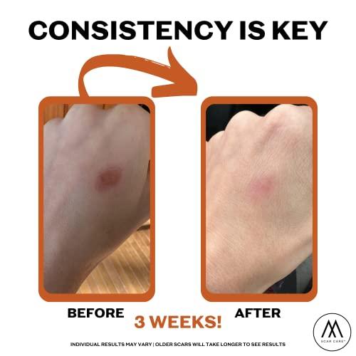 Motivo Scar Care Motivo Advanced Scar Care Bundle: Scar Tape & Roller Serum (10ml) | Water & Sweat Resistant, Long-Lasting, Suitable for All Skin Types | Ideal for Surgical, C-Section, Trauma, & Acne Scars | Espresso