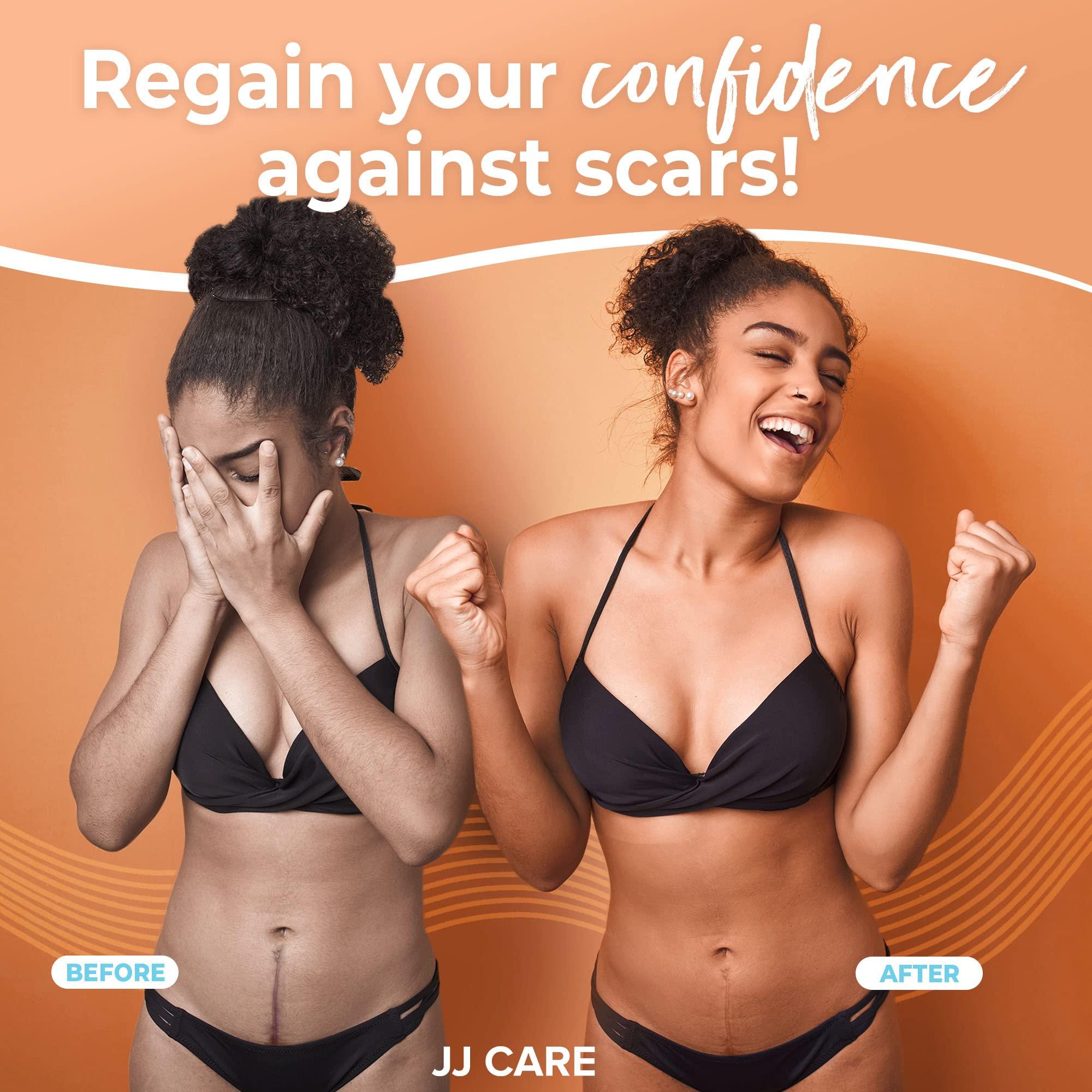 JJ CARE Soft Silicone Tape, 1.6” x 120” Flexible Silicone Scar Tape, Medical Grade Silicone Strips for Scars, Washable & Reusable Scar Tape for Surgical Scars, Latex-Free Scar Tape