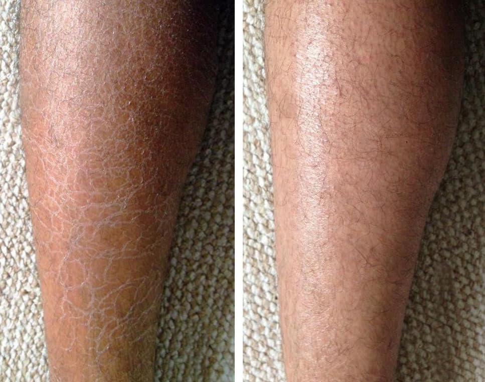 G16 Lotion G16 Skin Repair, Very Dry Skin & Ichthyosis Treatment Cream & Lotion