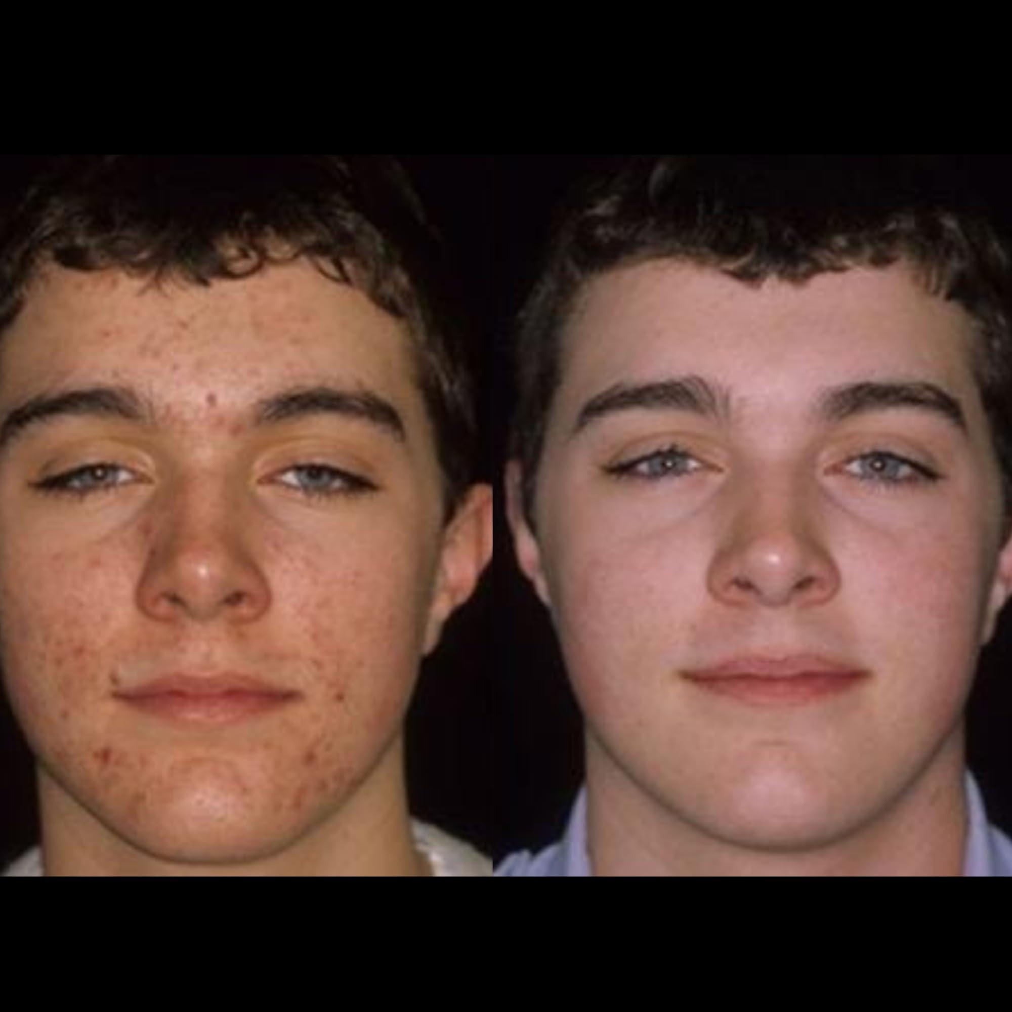 Acnetame Acnetame 4 Pack- Vitamin Supplements for Acne Treatment- Hormonal Pimple Tablets to Clear Oily Skin for Women, Men, Teens, and Adults