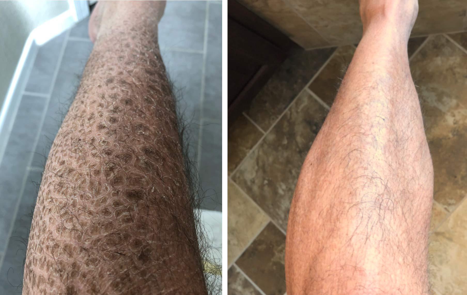 G16 Lotion G16 Skin Repair, Very Dry Skin & Ichthyosis Treatment Cream & Lotion