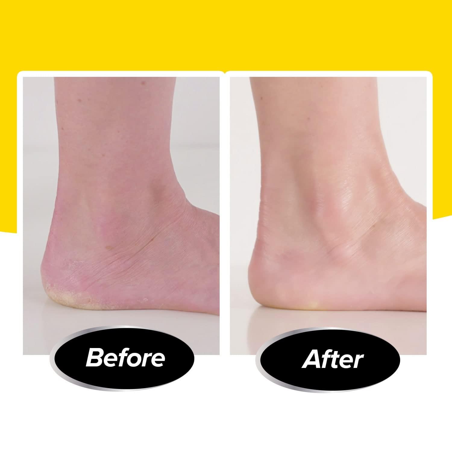 PediVac PediVac As Seen On TV Electric Callus Remover + Built-In Vacuum Sucks Up Shavings,Gently Removes Calluses & Dry Skin in Seconds, Mess-Free, Spins at 2000 RPMs, LED Light, 2 Speed Settings, 3.5\"x 2.5\"