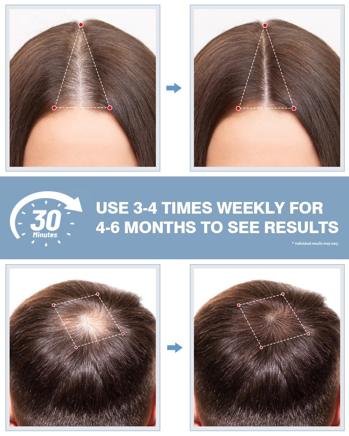 LONLIKE LONLIKE Light Therapy Hat, Red Light Cap for Head with Timer & Controller, Red Light 630nm Infrared Light 850nm 940nm Infrared Therapy Cap