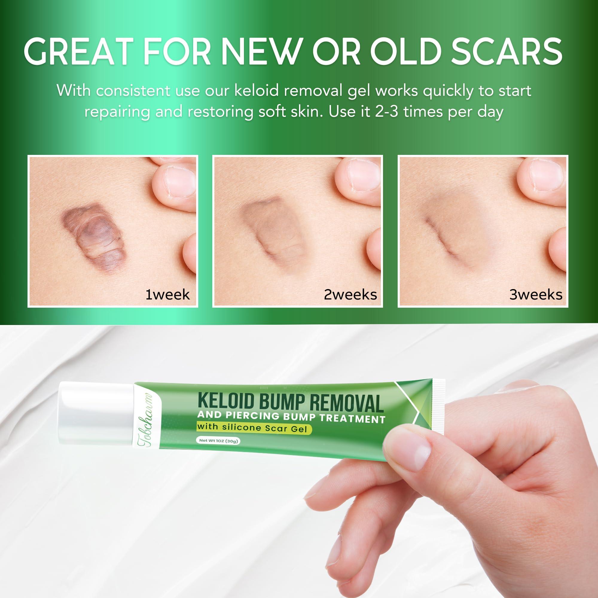 Tobcharm Advanced Keloid Bump Removal Gel: Silicone Keloid Scar Removal Cream for Scars from Piercing, Surgical Marks, Acne, and Burns, Keloid Treatment for Ears, Face, and Body with Healing Formula 30g
