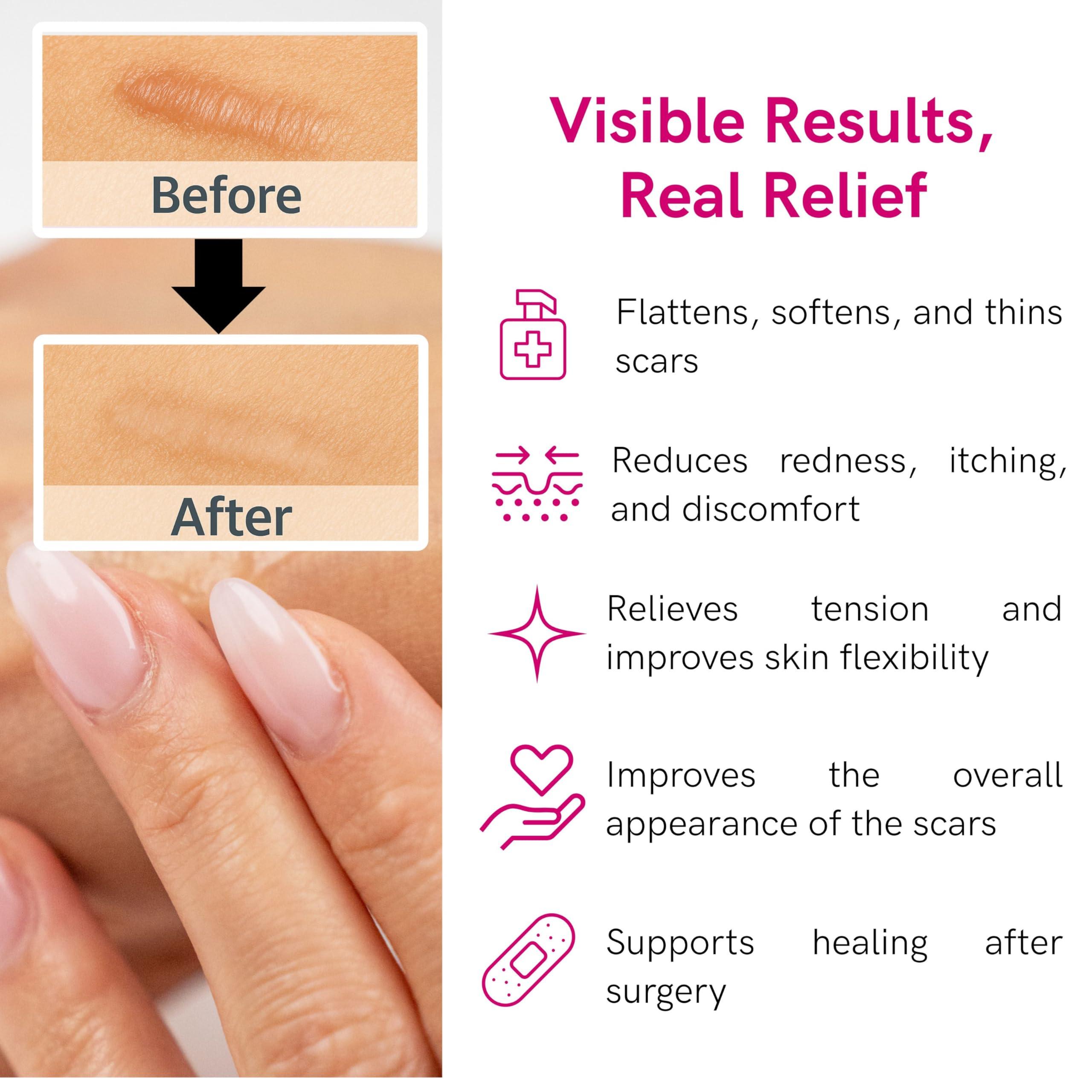 LIPOELASTIC LIPOELASTIC Silicone Scar Cream for Surgical Scars, Medical Grade Silicone Scar Gel with Vitamin E for C-Section, Burn, Stretch Marks, Wound, Old Scar, Acne Scar Treatment, Crema para Cicatrices