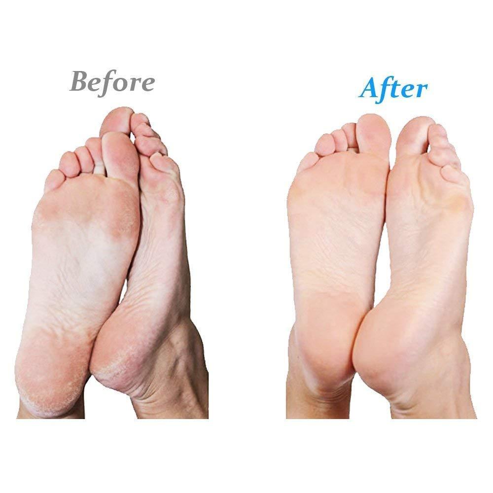 Emjoi Emjoi Micro-Pedi Battery Operated Callus Remover