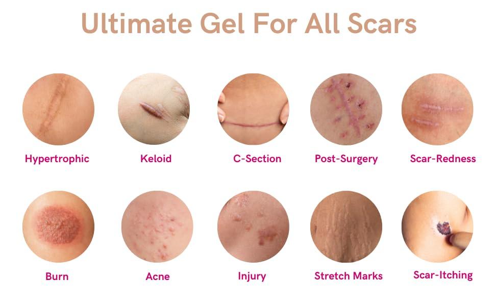 LIPOELASTIC LIPOELASTIC Silicone Scar Cream for Surgical Scars, Medical Grade Silicone Scar Gel with Vitamin E for C-Section, Burn, Stretch Marks, Wound, Old Scar, Acne Scar Treatment, Crema para Cicatrices