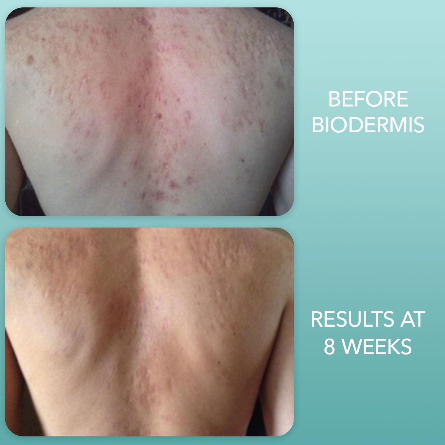 BIODERMIS Biodermis Episof Silicone Scar Gel Pump, Premium Grade Skin Repair Silicone Gel for Scars, Stretch Marks, Fine Lines & Wrinkles - Advanced Scar Care, Fast-Drying, Non-Oily, Scar Cream Post Surgery