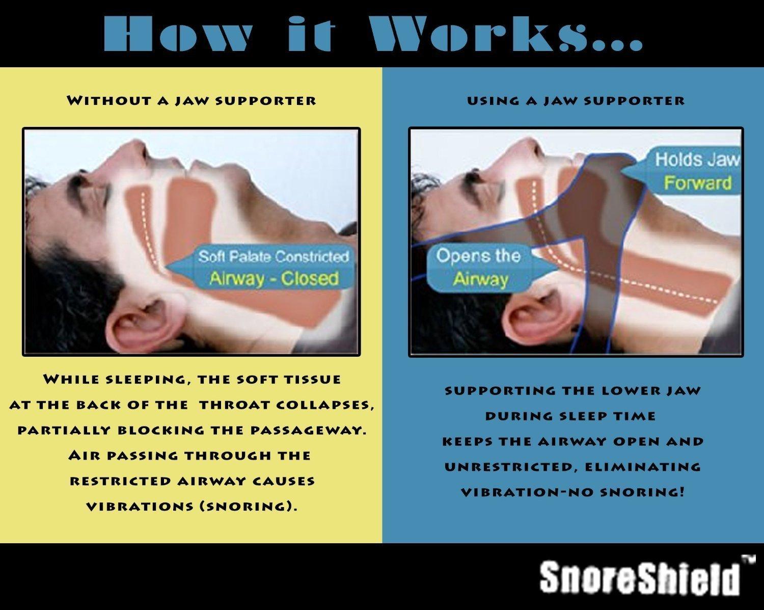 SnoreShield(TM) SnoreShield Anti Snore Chin Strap - The #1 Ranked Snoring Sleep Solution - Natural And Comfortable Instant Snore Stopper - Easy To Use And Adjustable
