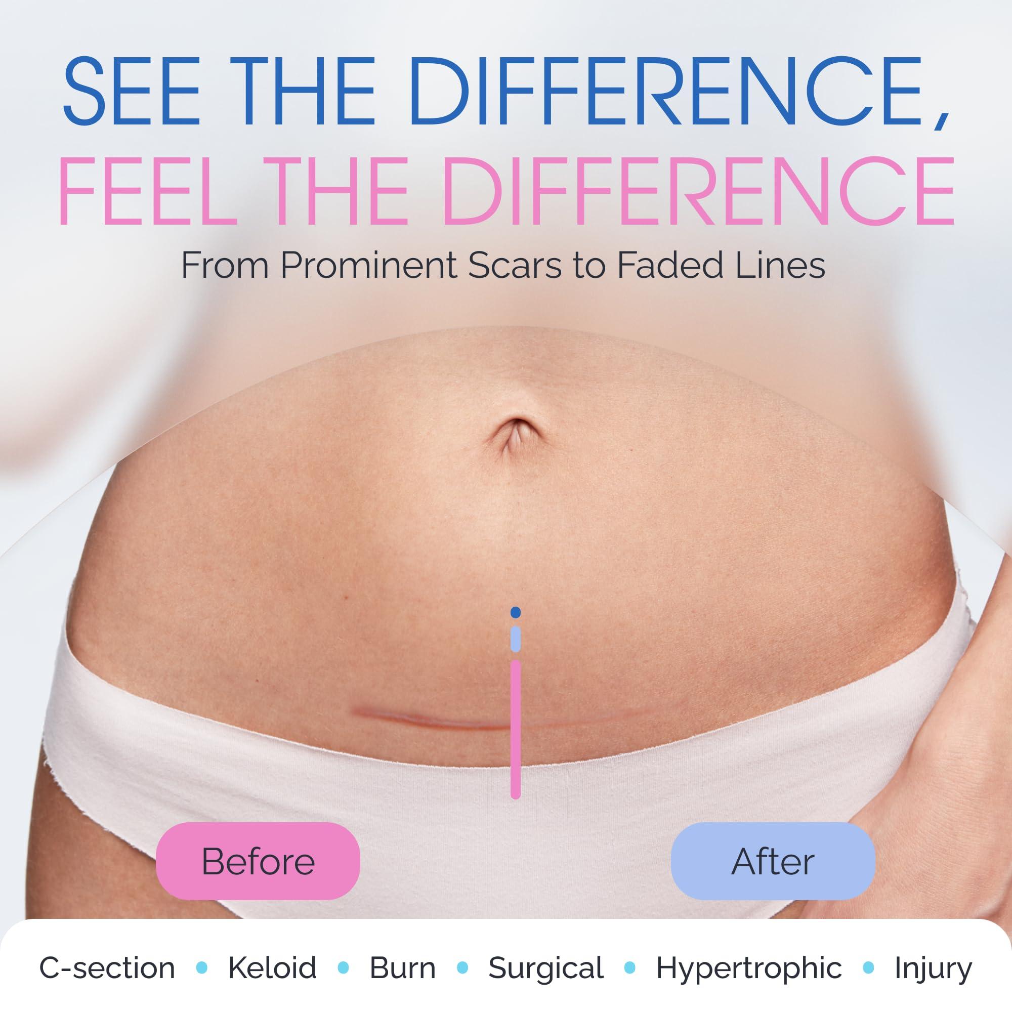 ScarScience ScarScience C-Section Recovery Kit - Advanced Scar Treatment after C-Section - Medical Grade Waterproof Silicone Scar Sheets for Scar Removal, 8 Strips + Silicone Gel for Scars and Surgical Scars,18ml