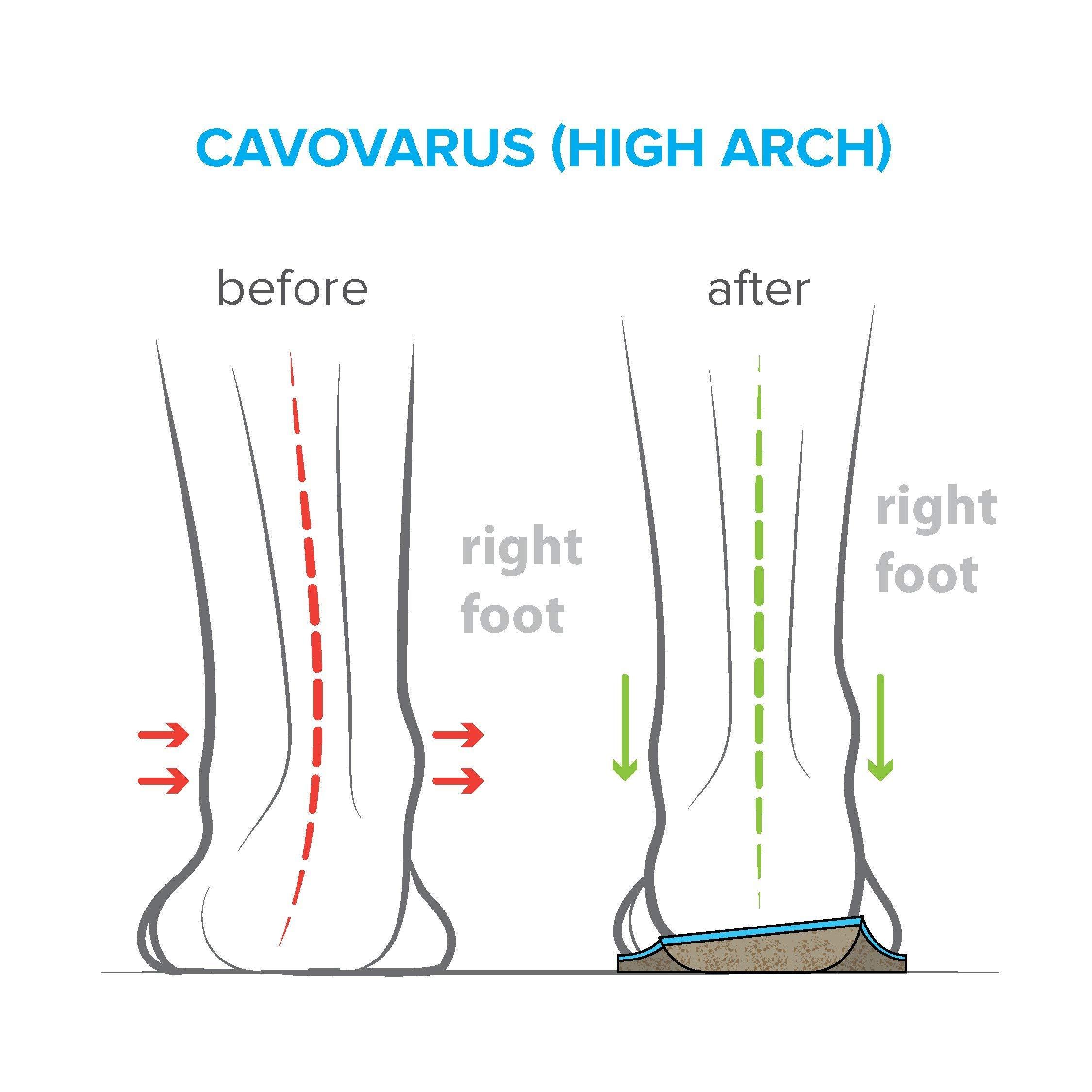 FootScientific FootScientific® Arches Type 3 (High Arch) Orthotic Shoe Insoles, Men’s Size 11-11.5 / Women’s Size 13-13.5