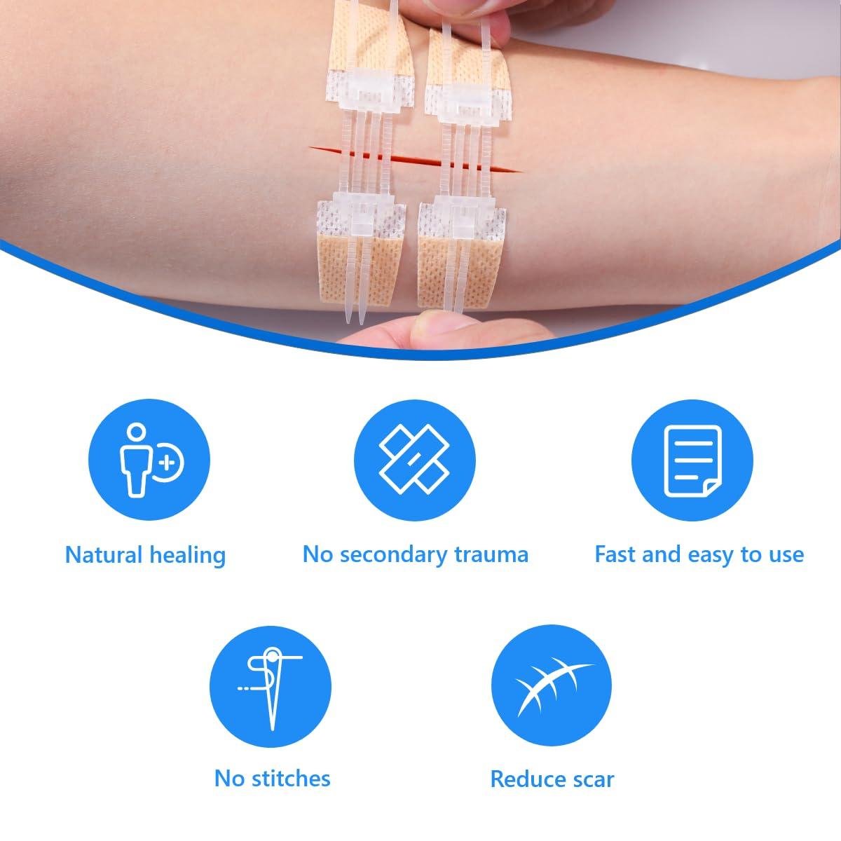 Longmed Longmed Emergency Wound Closures - 10 Pcs Zipper Wound Closure Device Painless Stitch Sutures Laceration Repair Without Stitches Adhesive Bandages for First Aid Wound Care(Factory Direct Sale)
