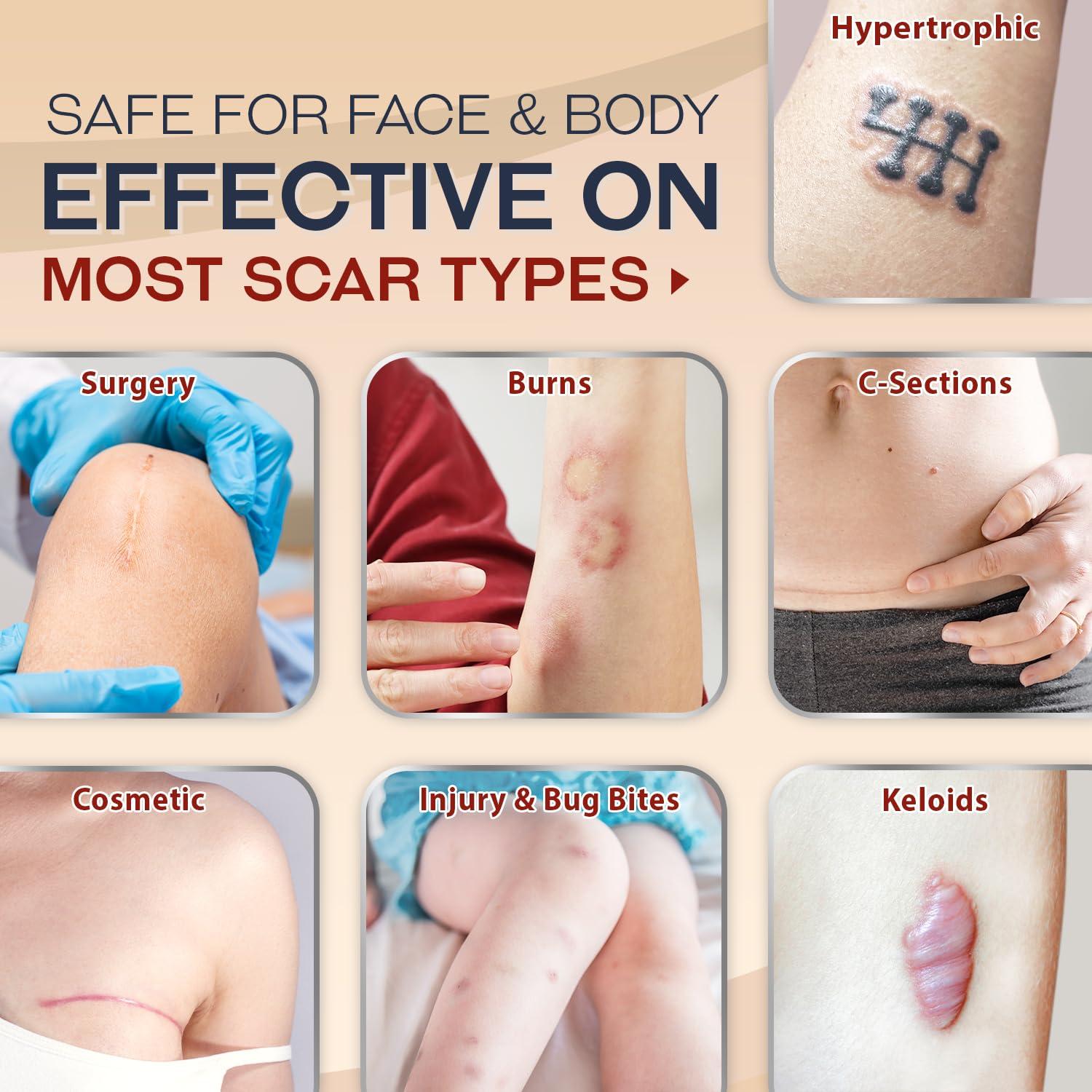 Ebanel Ebanel Advanced Silicone Scar Gel with Allantoin, Emu Oil, Vitamin E and Onion Extract, Medical-Grade Cream for Old & New Scars from Surgeries, C-Section, Injuries, Burns, Keloids & More