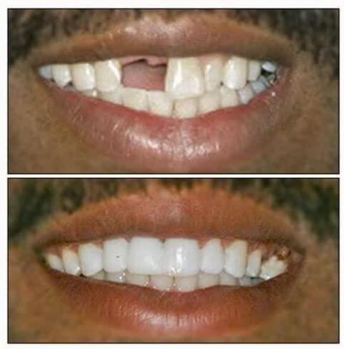 Dentemp Dentemp Recap-It Cap and Crown Repair Dental Kit - Fast Acting Formula Dental Cement for Loose Caps (Pack of 3) - Temporary Cement for Crown and Bridge