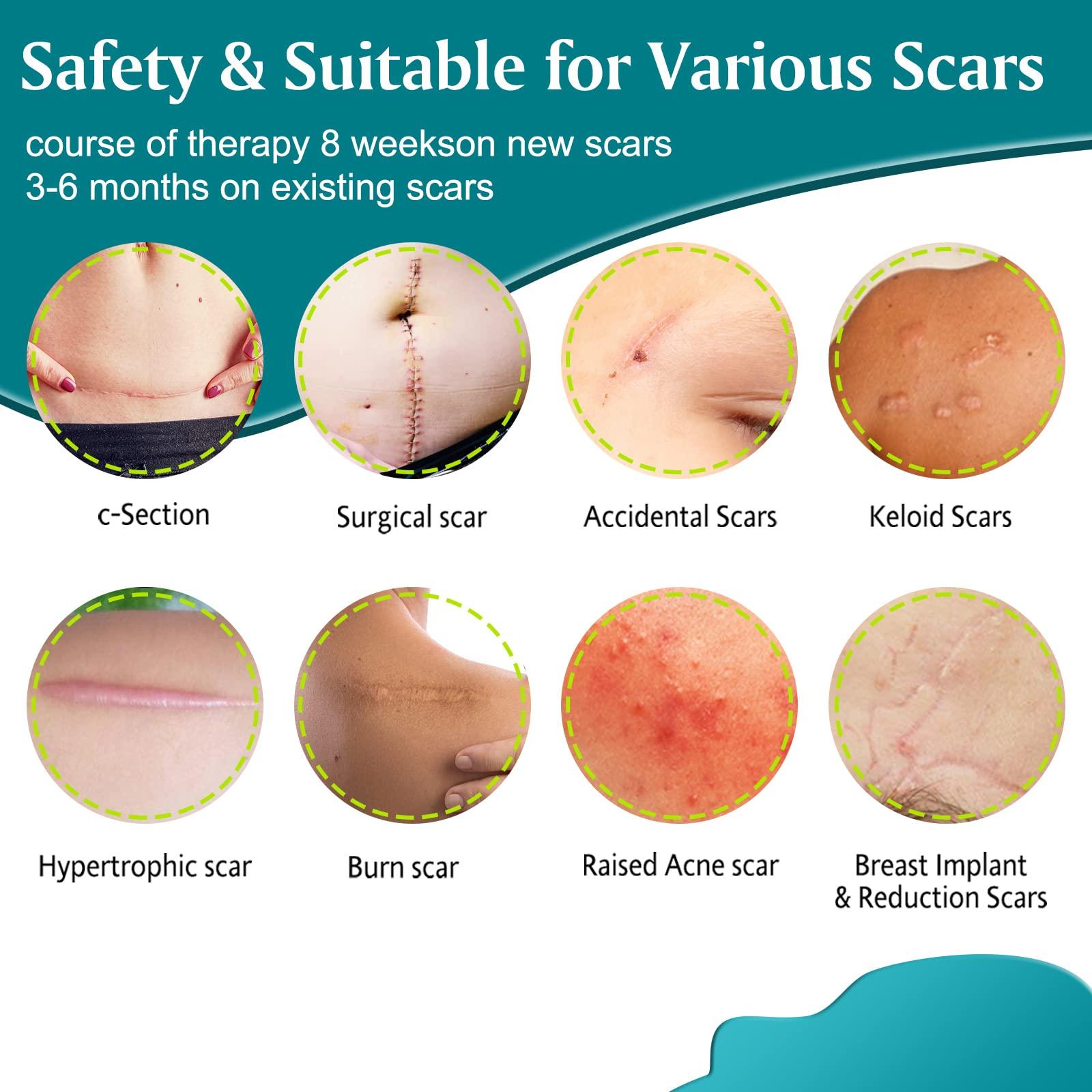 RTBYUE Silicone Scar Sheets,Professional Silicone Tape for Scars(16 pads-5.9x 1.6),Silicone Scar Tape,Scar Removal Sheets,Silicone Scar Strips for Surgical Scars, C-Section, Surgery, Burn, Keloid, Acne