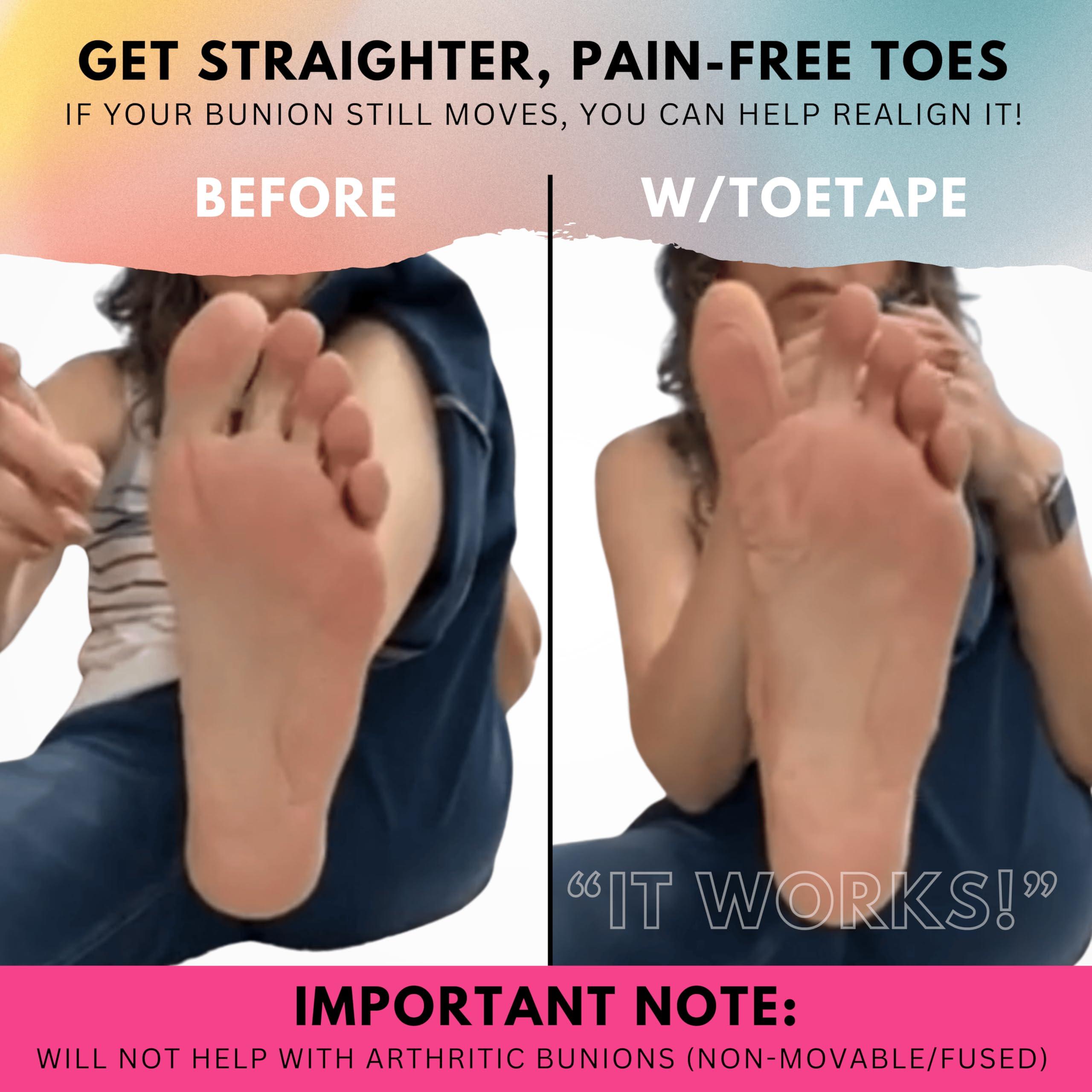ToeTape Bunion Correction & Pain Relief Tape | 40 Count | Precut Kinesiology Tape for Bunions, Big Toe Sprains, Pain Relief and Support | Hypoallergenic and Sweatproof (Nude)
