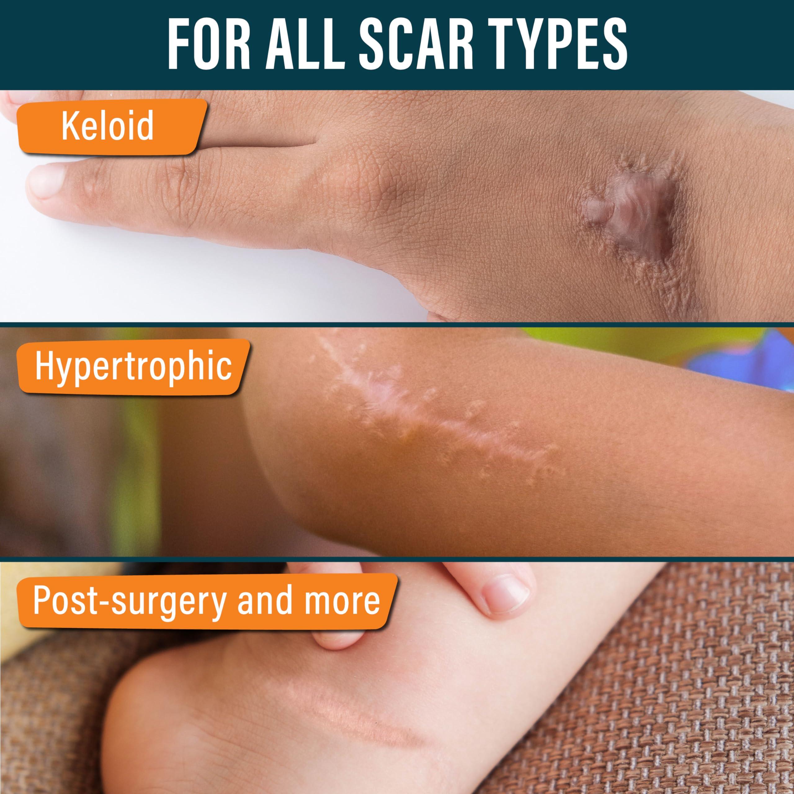 NUVADERMIS NUVADERMIS Silicone Scar Tape for Kids - Scar Tape for Surgical Scars - 120\" x 1.5\" Roll - Reusable Medical Grade Silicone Scar Tape for Children - 1 Pack - Dinosaurs