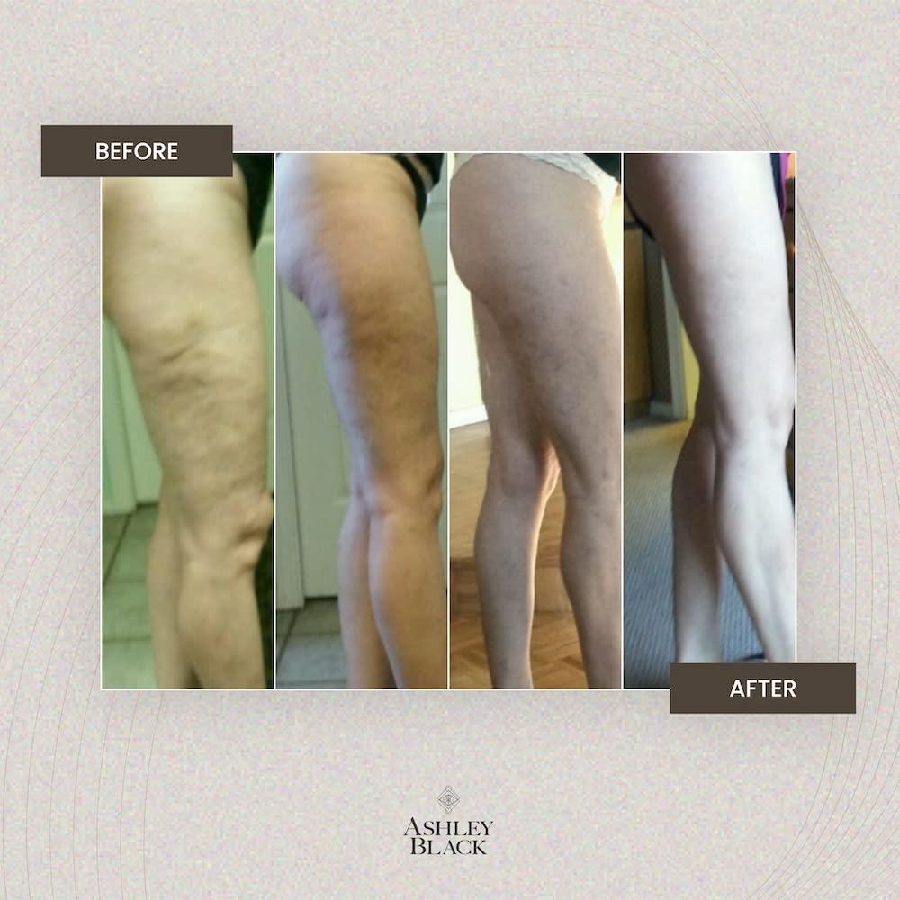 FasciaBlaster Mini 2 by Ashley Black - Patented Cellulite & FasciaBlaster Tools - Handheld Massager Pressure Point Release Tool