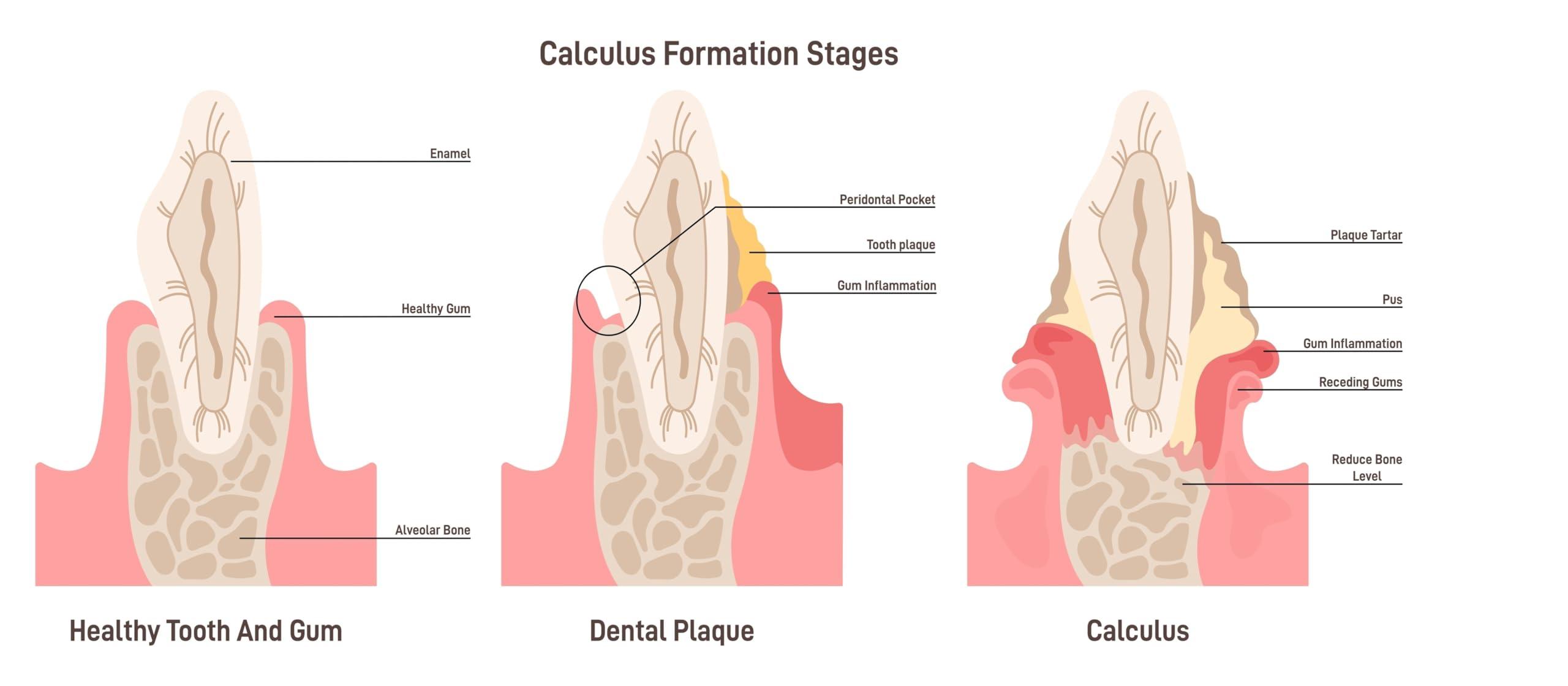 Generic Cocorange Brite Anti-Plaque and Anti-Tartar Teeth Cleaner - Remove Plaque in Days and Tartar Removal from Home (Additional Honey, 2 fl oz)