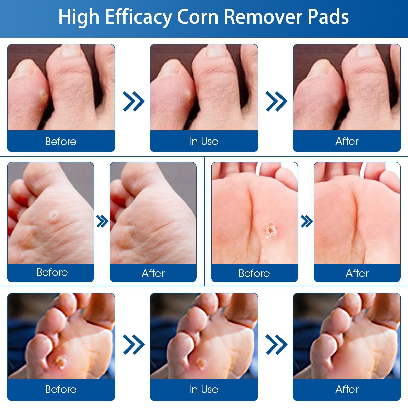 MQUPIN 24 Count Corn Removal Pads for Feet and Toe, Corn Feet Remover for Feet Extra Strength, Callous Remover
