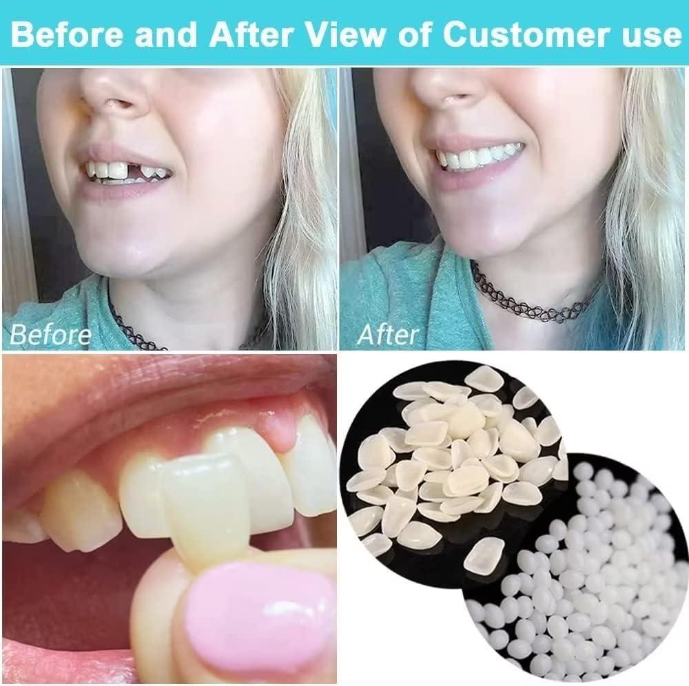 womcare Fake Tooth Repair Kits DIY Dental Care Kit Glue for Filling Missing Broken Teeth Crowns and Bridges Moldable Fake Teeth to Regain Your Beautiful Smile in Minutes-White Color