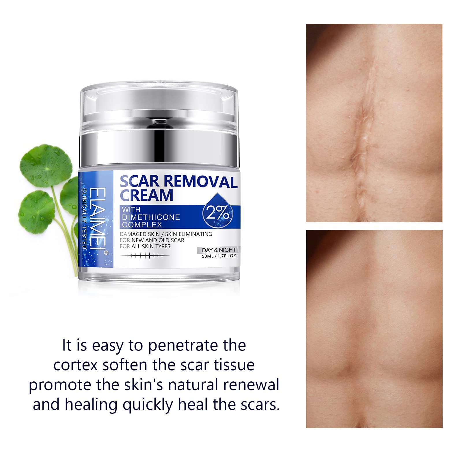 RTBYUE Scar Removal Cream - Advanced Scar Treatment Gel for Surgical Scars, Acne Scars, C-Section, Burns, Stretch Marks - for Old and New Scars