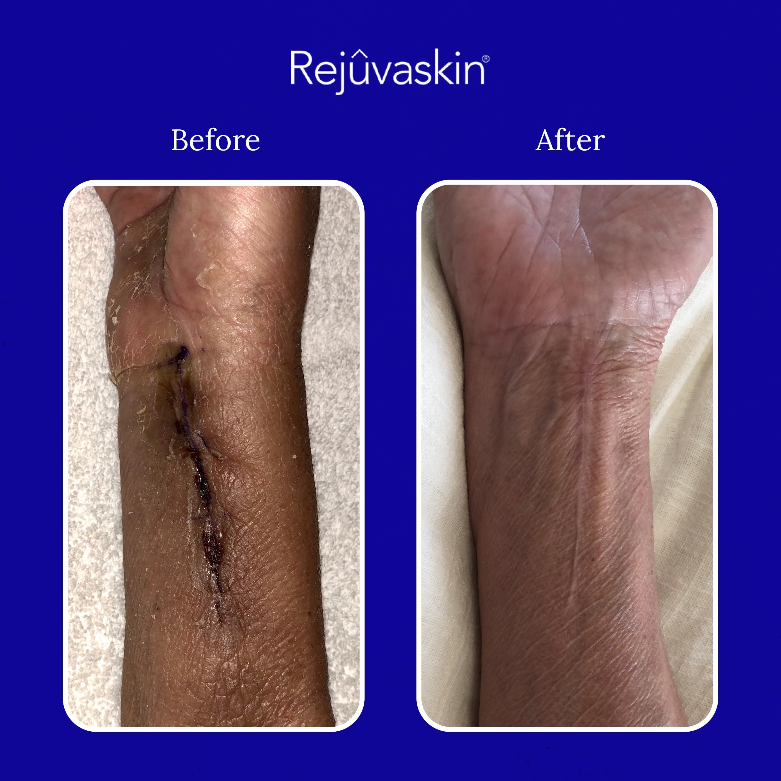 Rejuvaskin Rejuvaskin Scar Heal Kit for Small to Medium Scars, Soften, Flatten, Reduce and Recover, Silicone Sheeting, RejuvaSil Gel & Medical Tape, 1.5\" x 5\"