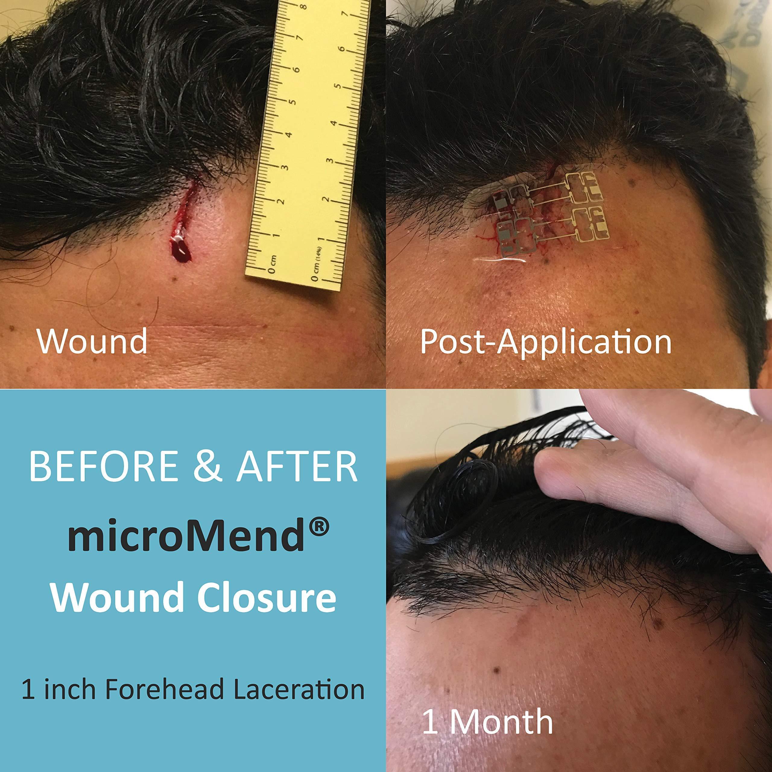 microMend microMend Emergency Wound Closures Surgical Quality Laceration Repair Without Stitches - Think Ahead - Be Prepared - Add to Your Survival Kit, Camping Gear (Multi Pack - 3 Packs of 2 Medium Devices)